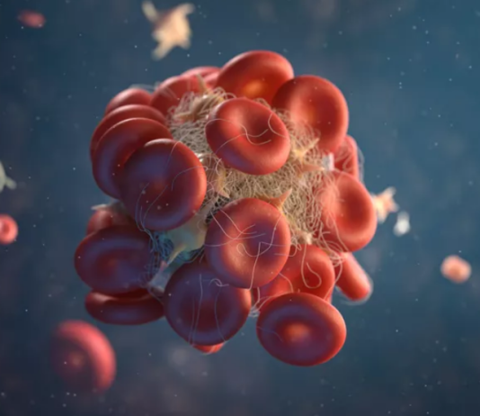 SIMPTOMI KRVNIH UGRUŠAKA U TIJELU: AKO TO PRIMIJETITE, ODMAH POTRAŽITE MEDICINSKU POMOĆ