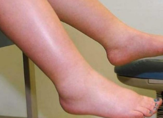 EVO KAKO DA IZBACITE VIŠAK VODE IZ TIJELA: Noge vam više neće biti natečene, evo šta trebate uraditi