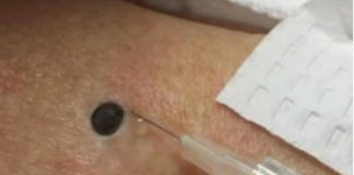 ŽENA JE GAJILA OVO NA LEĐIMA: Kada je doktorka uzela špric i bocnula, shvatit ćete zašto je SNIMAK pregledalo 33 miliona ljudi!