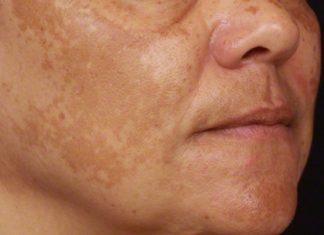 SMEĐE MRLJE SA LICA SE MOGU UKLONITI: Dermatolog otkrio tajnu, smjesa ova dva sastojka čini čuda – LICE ĆE VAM PONOVO BITI ČISTO