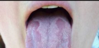 ZAUVIJEK SE RIJEŠITE KANDIDE: Ovaj recept se rješava ove opasne gljivice!