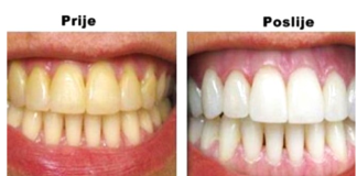 Izbjelila je zube bez jednog dinara: Samo je prokuhala ovaj sastojak, a rezultati su nevjerovatni!