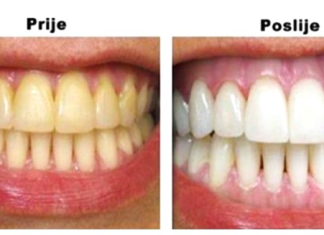 Izbjelila je zube bez jednog dinara: Samo je prokuhala ovaj sastojak, a rezultati su nevjerovatni!
