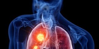 RASTE BROJ ZARAŽENIH HODAJUĆOM UPALOM PLUĆA: Ako imate ove simptome treba da se odmah javite ljekaru