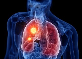 RASTE BROJ ZARAŽENIH HODAJUĆOM UPALOM PLUĆA: Ako imate ove simptome treba da se odmah javite ljekaru