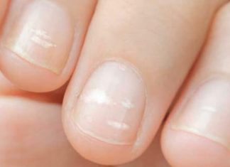 Ako primetite ovu promenu na noktima, hitno idite kod lekara! Jedan detalj je posebno važan