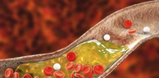 Zbog ovih 12 skrivenih razloga holesterol raste kao lud: Dok vi mislite da se hranite zdravo, u venama se talože masnoće koje guše srce