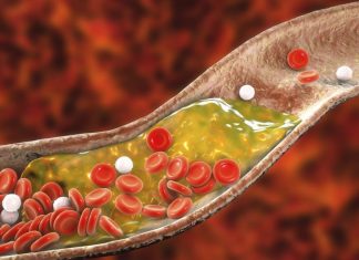 Zbog ovih 12 skrivenih razloga holesterol raste kao lud: Dok vi mislite da se hranite zdravo, u venama se talože masnoće koje guše srce