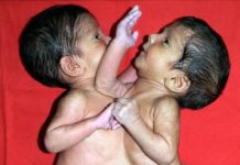 Maja je rodila ćerke spojene srcem i ostavila ih u bolnici: Sudbina sijamskih bliznakinja podigla celu naciju na noge, a kad su ih razdvojili usledio pakao