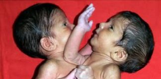 Maja je rodila ćerke spojene srcem i ostavila ih u bolnici: Sudbina sijamskih bliznakinja podigla celu naciju na noge, a kad su ih razdvojili usledio pakao