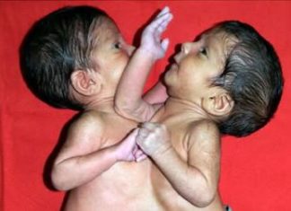 Maja je rodila ćerke spojene srcem i ostavila ih u bolnici: Sudbina sijamskih bliznakinja podigla celu naciju na noge, a kad su ih razdvojili usledio pakao