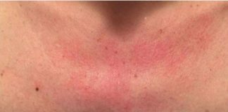 Zašto me tijelo svrbi nakon tuširanja? Ako i vi imate crvene mrlje, evo zašto..FOTO