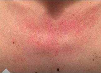 Zašto me tijelo svrbi nakon tuširanja? Ako i vi imate crvene mrlje, evo zašto..FOTO