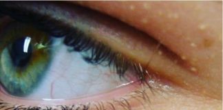 NI SLUČAJNO IH NE ISTISKUJTE, IMATE LI OVE BIJELE TAČKICE NA LICU? Uklanjaju se jednstavno, TREBAJU VAM 3 SASTOJKA KOJA IMATE U KUĆI