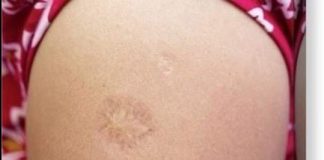 Svi rođeni u Jugoslaviji imaju ovaj ožiljak na ruci: Znate li kako je nastao i zbog čega? Svi su iznenađeni