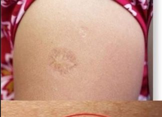 Svi rođeni u Jugoslaviji imaju ovaj ožiljak na ruci: Znate li kako je nastao i zbog čega? Svi su iznenađeni