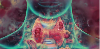 Sedam ranih simptoma raka grla koje ne smete ignorisati: Često se mešaju sa bezazlenim infekcijama