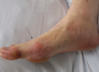 OVO SU ZNAKOVI DA VAM ŠEĆER RAZARA ORGANIZAM: Obratite pažnju