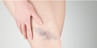 Rani znakovi nedostatka vitamina C koje ne biste smjeli zanemariti