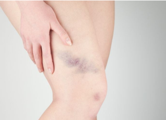 Rani znakovi nedostatka vitamina C koje ne biste smjeli zanemariti