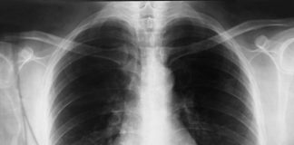 OD GNOJENJA DO OTKAZIVANJA ORGANA! Ovo su glavni simptomi UPALE PLUĆA! Odnela i slavnu OSKAROVKU