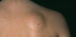 Ukoliko imate masno tkivo na koži, pročitajte tekst kako bi nestao prirodnim putem