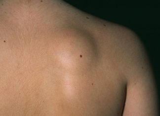 Ukoliko imate masno tkivo na koži, pročitajte tekst kako bi nestao prirodnim putem