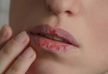 Naljbolji savjeti naših stručnjaka….„Kako spriječiti suhe i ispucale usne tokom hladnih dana“.