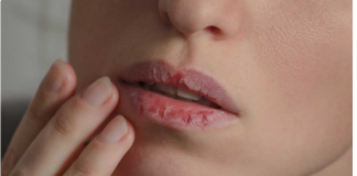 Naljbolji savjeti naših stručnjaka….„Kako spriječiti suhe i ispucale usne tokom hladnih dana“.