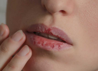 Naljbolji savjeti naših stručnjaka….„Kako spriječiti suhe i ispucale usne tokom hladnih dana“.