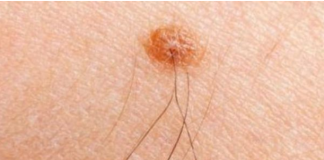 Iz mladeža vam raste dlaka? Evo šta to znači i kako da prepoznate da je opasan po zdravlje – vodite računa