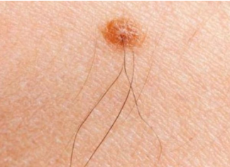 Iz mladeža vam raste dlaka? Evo šta to znači i kako da prepoznate da je opasan po zdravlje – vodite računa