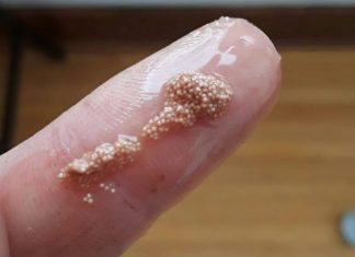 Bele grudvice u jajetu: šta to zaista znači i da li treba da brinete?