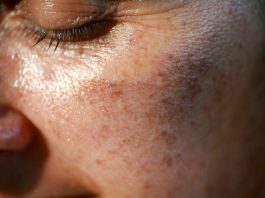 MAZALA JE LICE SA OVIM, STARAČKE PJEGE SU NESTALE: Ovako se zauvijek riješite SMEĐIH MRLJA sa kože, savjetuje poznati dermatolog