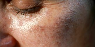 MAZALA JE LICE SA OVIM, STARAČKE PJEGE SU NESTALE: Ovako se zauvijek riješite SMEĐIH MRLJA sa kože, savjetuje poznati dermatolog