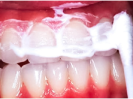 Držite ovu smjesu u ustima 60 sekundi i uklonit ćete vecinu kamenca sa zuba!