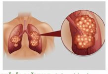 PUŠAČI, PAŽNJA! Za 3 dana izbacite sve otrove iz tijela: Ova metoda skida OTROV SA ZIDOVA PLUĆA, sprečava rak, izbacuje masnoće i višak vode!
