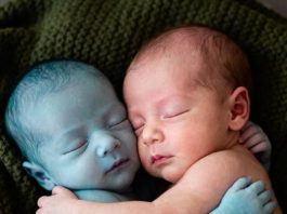 Kad je medicinska sestra stavila bebu bez života pored njene zdrave blizanke, samo je željela reći zbogom. Ali ono što se dogodilo nakon toga natjeralo ju je da padne na koljena u suzama…