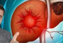 Evo kako se bolesna jetra pokazuje na koži,nogama? OVO SU SIMPTOMI BOLESNE JETRE…