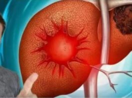 Evo kako se bolesna jetra pokazuje na koži,nogama? OVO SU SIMPTOMI BOLESNE JETRE…