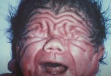 Na rođenju je izgledao kao Šar pej, ni lekari nisu mogli da objasne kako je to moguće: Ljudi tek ostanu u čudu kad vide kako izgleda 30 godina kasnije