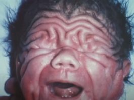 Na rođenju je izgledao kao Šar pej, ni lekari nisu mogli da objasne kako je to moguće: Ljudi tek ostanu u čudu kad vide kako izgleda 30 godina kasnije