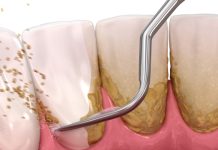 Evo kako sami da skinete kamenac sa zuba. Ove jeftine sastojke već imate kod kuće! (FOTO)