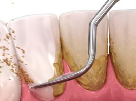 Evo kako sami da skinete kamenac sa zuba. Ove jeftine sastojke već imate kod kuće! (FOTO)