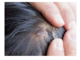 BUBULJICE NA GLAVI SU SVE ČEŠĆI PROBLEM: Ni slučajno ih ne istiskujte, evo zašto se javljaju I ŠTA TREBATE URADITI DA NESTANU