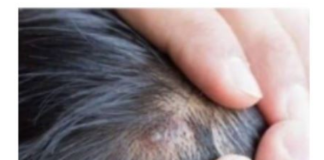 BUBULJICE NA GLAVI SU SVE ČEŠĆI PROBLEM: Ni slučajno ih ne istiskujte, evo zašto se javljaju I ŠTA TREBATE URADITI DA NESTANU