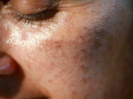 MAZALA JE LICE SA OVIM, STARAČKE PJEGE SU NESTALE: Ovako se zauvijek riješite SMEĐIH MRLJA sa kože, savjetuje poznati dermatolog