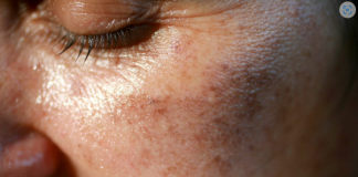 MAZALA JE LICE SA OVIM, STARAČKE PJEGE SU NESTALE: Ovako se zauvijek riješite SMEĐIH MRLJA sa kože, savjetuje poznati dermatolog