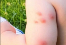 KOMARCI VAM PRAVE PAKAO OD ŽIVOTA? Samo isijecite OVO VOĆE na pola i ostavite u sobi, VIŠE IH NIKADA NEĆETE VIDJETI BLIZU!