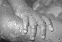 U zemlji pored naše širi se smrtonosan virus: 446 zaraženih, najugroženija je jedna grupa ljudi